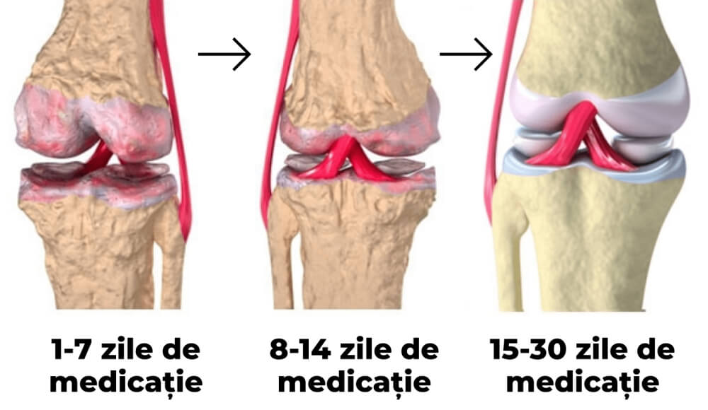 Recuperare articulații în 30 zile