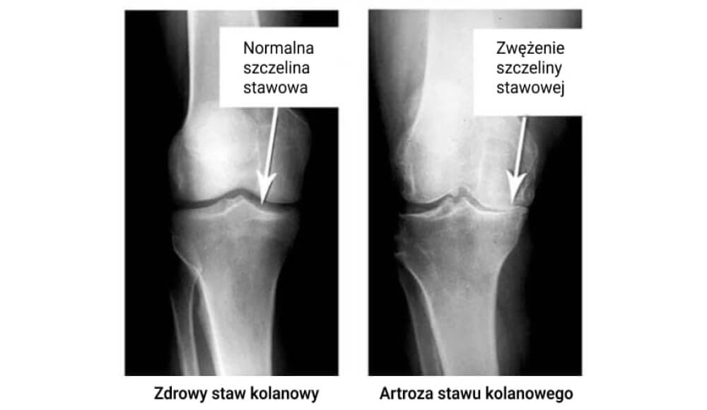 Fotocolaj comparativ al radiografiilor genunchiului sănătos și bolnav